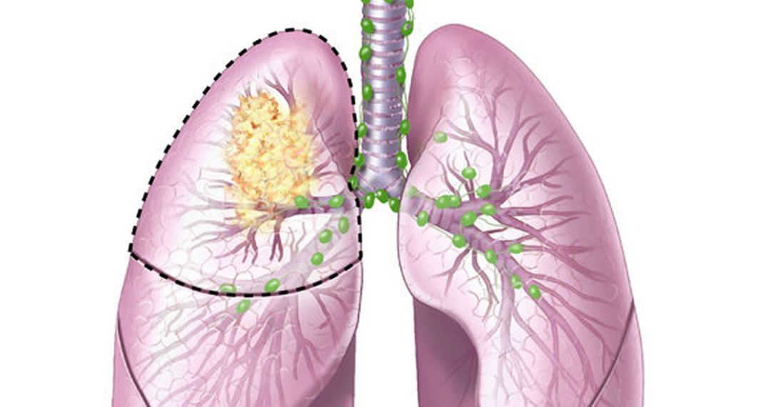 Akciğer kanserinin kaç çeşidi vardır?